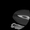 SPORK, NICO - 22.03.1976 - 02.08.2022 - CT obere Extremität - 17:51:17